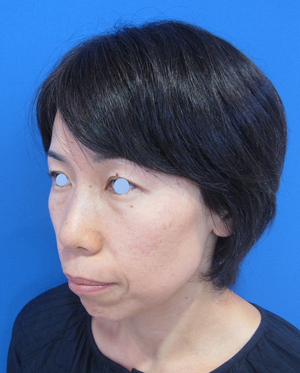 目の下のたるみ、目のくまでお悩みの方、切らずに完璧に解決します。TCB-R法　手術直後　症例写真